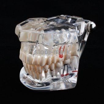 1PCS Dental Implant Disease Teeth Model With Restoration BridgeTooth Dentist For Medical Science Teaching NEW - Intl June 2018 - 2 1PCS Dental Implant Disease Teeth Model with Restoration BridgeTooth Dentist for Medical Science Teaching NEW - intl - 2