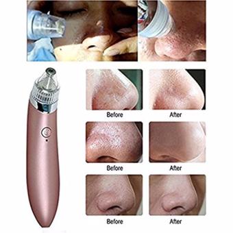 Blackhead Remover,Bigaint Rechargeable Electronic Acne RemoverFacial Pore Cleaner Utilizes Pore Vacuum Extraction(ROSE GOLD) June 2018 - 2 Blackhead Remover,Bigaint Rechargeable Electronic Acne RemoverFacial Pore Cleaner Utilizes Pore Vacuum Extraction(ROSE GOLD) - 2