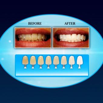 Fast Working Highly Effective 20 Minutes Dental White TeethWhitening April 2018 - 4 Fast Working Highly Effective 20 Minutes Dental White teethWhitening - 4
