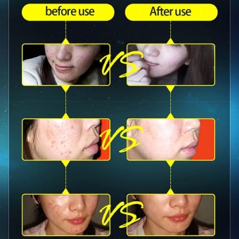 Makiyo Face Anti Acne Blain Cream Oil Control Shrink Pores Treatment Cream Print Scar Remover Skin Hole Repair Skin Care - Intl June 2018 - 5 Makiyo Face Anti Acne Blain Cream Oil Control Shrink Pores Treatment Cream Print Scar Remover Skin Hole Repair Skin Care - intl - 5